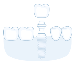 single dental implant illustration